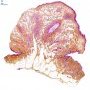 Nevus lipomatosus superficialis