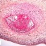 Acute chorioamnionitis