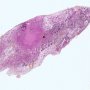 Pulmonary nodule in lymphomatoid granulomatosis