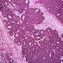 Triphasic Wilms tumor