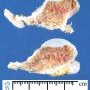 Osteochondroma. Section. Macroscopy