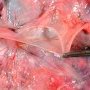 Placental amniotic band