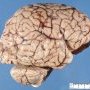Normal brain