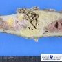 Non-ossifying fibroma