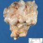 Femoral osteochondroma