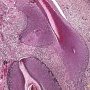Basaloid pilomatricoma