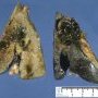 Cystic dilatation of large bile ducts in extrahepatic biliary tract (...)