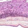 Acute chorioamnionitis