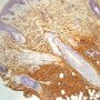 CD34 immunostaining in dermatofibrosarcoma protuberans