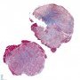 Intramuscular lobular capillary hemangioma