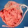 Velamentous insertion of umbilical cord