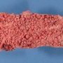 Familial adenomatous polyposis