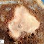 Placental intervillous thrombus
