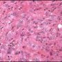 Epithelioid sarcoma