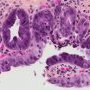 Biliary epithelial dysplasia in choledochal cyst