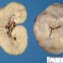 ARPKD kidney in a neonate (1 month)