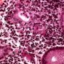 Acute glandulitis in active focal gastritis