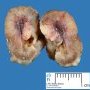 Colonic Peutz-Jeghers polyp