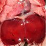 Medial liver in Ivemark syndrome