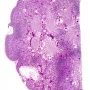 Renal cortical cysts