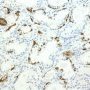 Atypical Adenomatous Hyperplasia - 34bE12 Immunostain