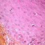 Apoptotic keratinocytes