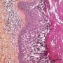 Epidermolytic hyperkeratosis