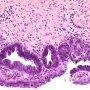 Biliary epithelial dysplasia in choledochal cyst