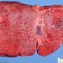 Micronodular cirrhosis in Wilson disease