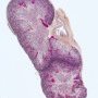 Normal renal structure - Right simple renal ectopia with renal (...)