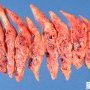 Massive placental infarction