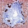 Ductular reaction or ductular proliferation (cytokeratin-7)