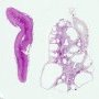 Renal adysplasia (renal agenesis and renal dysplasia)