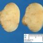 Mammary fibroadenoma
