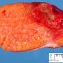 Testicular embryonal carcinoma
