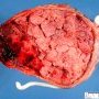Monochorionic monoamniotic gemellar placenta
