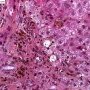 Epithelial dysplasia of interlobular biliary tract in chronic hepatic (...)