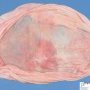 Ovarian serous cystadenoma