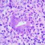 Acute colonic cryptitis in Crohn disease