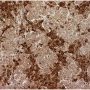 Thymic seminoma (CD68)