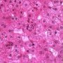 Lobular granulocyte aggregate