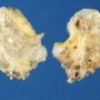 Osteochondroma