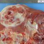 Leiomyomatous renal cell carcinoma