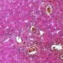 Portal cholestasis