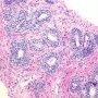 Basal Cell Hyperplasia in Prostate