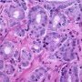 Gleason Pattern 3 (WebPathology)