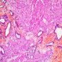 Ductal plate malformation (congenital hepatic fibrosis)