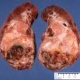 Wilms tumor with hilar invasion