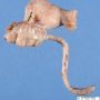 Ileal duplication cyst
