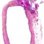 Perforated appendicitis